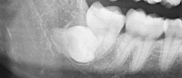 Deep Impacted Wisdom Tooth